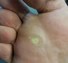 foot with a planter wart treatment at heal and soul health geelong west
